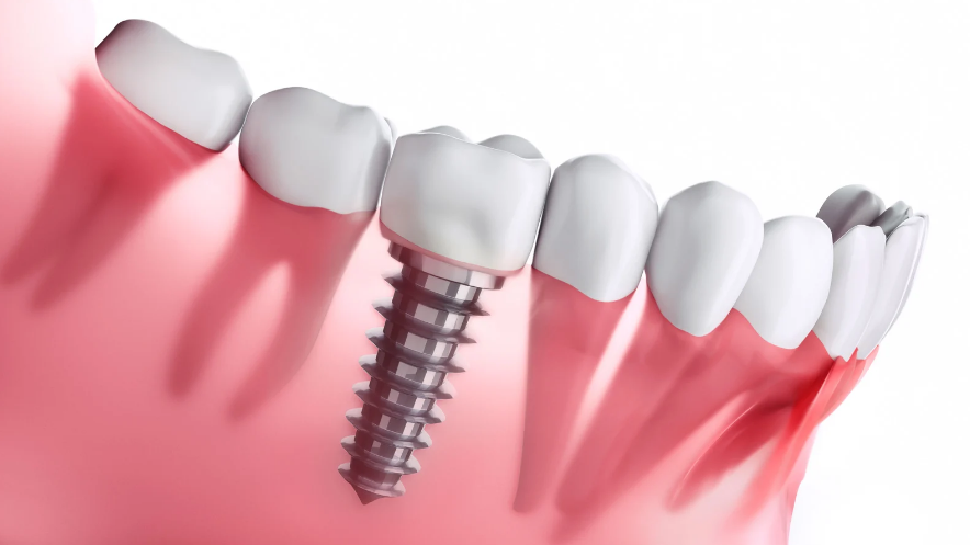 Remboursement des implants dentaires par les mutuelles